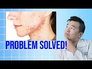 Beyond Acne: 5 Surprising Benefits of Benzoyl Peroxide