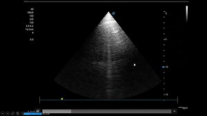 Understand the 3 steps of critical care U/S for successful weaning in 4 minutes. Register in our recorded online course to learn so many critical care U/S tricks which will change your way of management and boost your ICU skills. We are continuously upgrading our courses., so you will expect new lectures to be added to your course from time to time. Attention please, now the complete Lower Limb arterial and venous Doppler course is added to our recorded critical care U/S from basic to advanced c