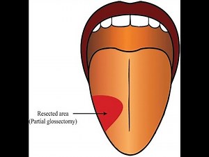 Hemiglossectomy | Radical Suprahyoid dissection | Uvulopalatopharyngoplasty (UPPP) | Dr Rams Academy