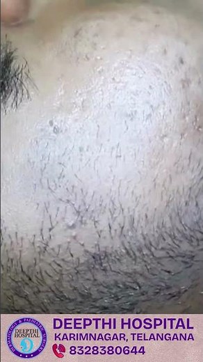 TCA CROSS Treatment for Deep Icepick Acne Scars