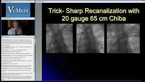 Sharp Recanalization Techniques for Chronic DVT