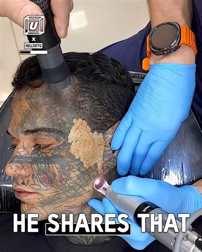 I got all my facial tattoos removed...🤯 #tattoos #LaserTattooRemoval | UNILAD