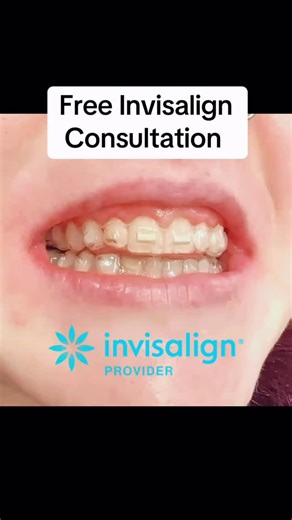 How Invisalign Works, Real Patient, Real Results Coming ✨ We’re often asked, how does Invisalign actually work? This video of this gorgeous patient starting out on their treatment journey in 2026 shows it perfectly. Invisalign works by gently moving your teeth using a series of clear aligners. Small composite buttons are placed on specific surfaces of the teeth, allowing controlled pressure to be applied exactly where it’s needed. This helps guide the teeth into their ideal position safely and p