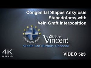 Congenital Stapes Ankylosis. Stapedotomy with Vein Graft Interposition & Teflon piston insertion