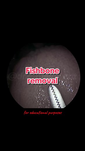 Fish bone removal #drshamim_ent #drshahmimsinuscenter #entspecialist #ent #hospitalpusrawi #learnontiktok #fyp #tulang #tulangikan #tercekiktulang #fishboneremoval #fishbone #malaysia #kualalumpur