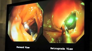 Colonoscopy Procedure