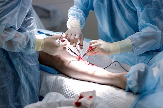 Stab Phlebectomy Leg Vein Surgery | Varicose Vein Surgical Therapy