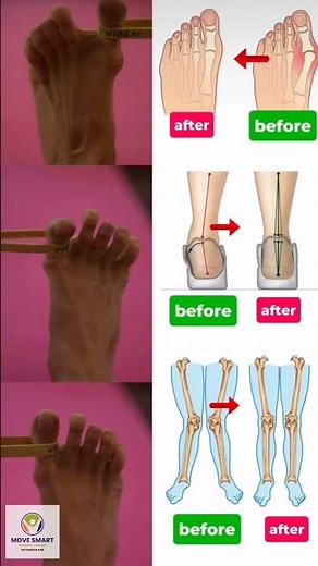 Fix Flat Feet & Bunions FAST! 🔥 Toe Band Exercise That Works #healthtips #flatfoot #plantarfasciitis
