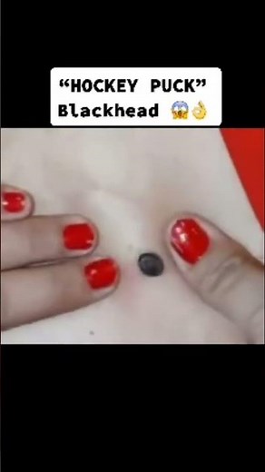 BLACKHEAD//DILATED PORE OF WINER