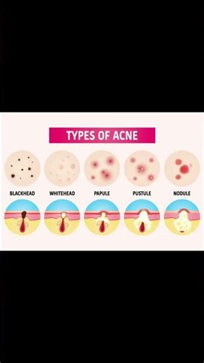 TYPES OF ACNE AND THERAPEUTICS #materiamedica #medicalbook