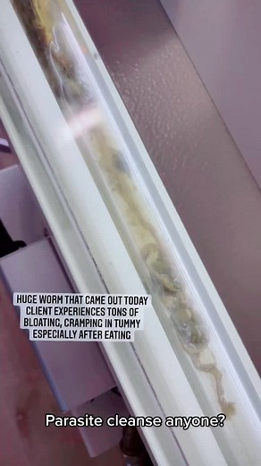 Got parasites? This client does! Sugar cravings, bloating, IBS... vivid dreams.. time for a cleanse! #parasitecleanse #parasites #colonic #ibs