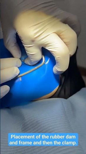 Placement of the rubber dam and frame and then the clamp. #endodontics #rubberdam #apexlore