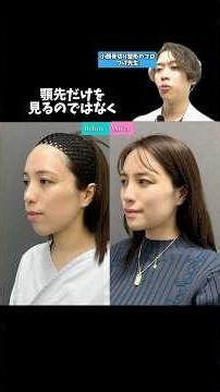 最後、僕の本音です、。 #東京美容外科 #骨切り #美容 #美容整形