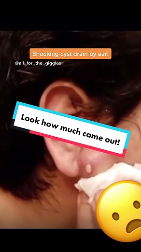 Crazy cyst frain. #cystdraining #cystexplosion #whiteheadsremoval #blackheadrrmovals #extractions #pimplepopperaddict