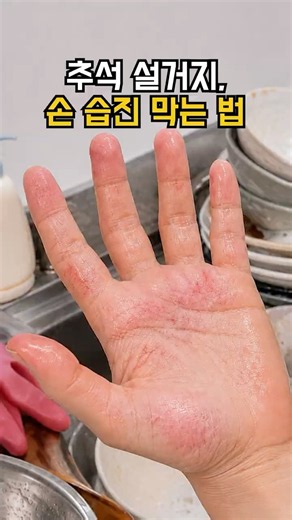 한포진·손습진 있다면 설거지 전 꼭 이렇게 하세요
