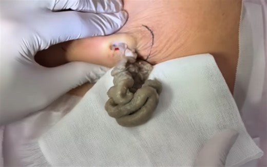 Huge Cottage Cheese Cyst Incision and Drainage