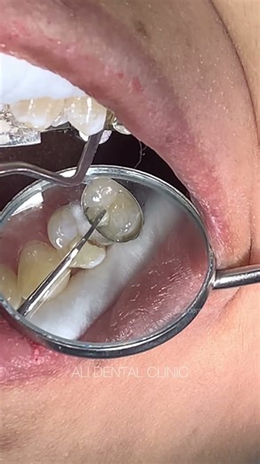 Class II Composite Restoration