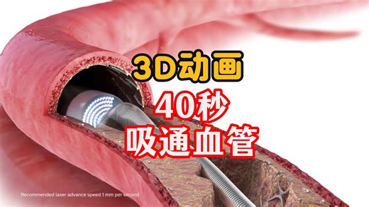 动脉粥样硬化血管，40秒涡轮增压技术切除斑块！