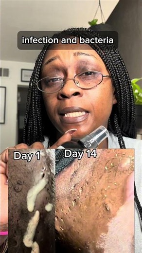 Hidradenitis Suppurativa is chronic, auto inflammatory, and has no cure. Here's how I get relief