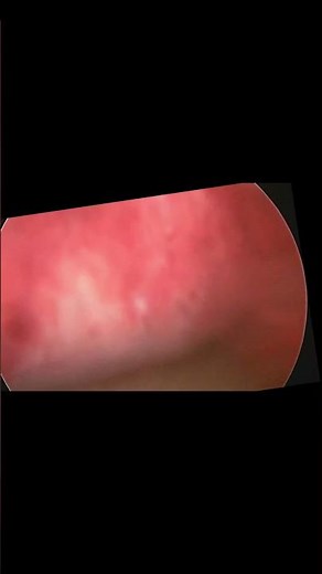 “Live Inside Uterus”Hysteroscopic procedure at Drashti Gynec Hospital.#visnagar #infertility #hope