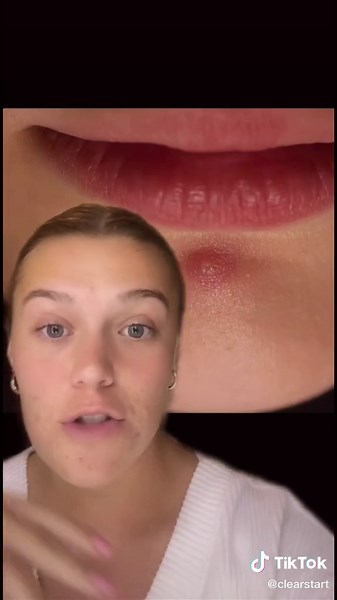 How to Identify and Treat Hormonal Acne and Blind Pimples