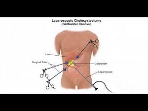 Laparoscopic cholecystectomy ; Definition, procedure, benefits, procedures, steps, complications