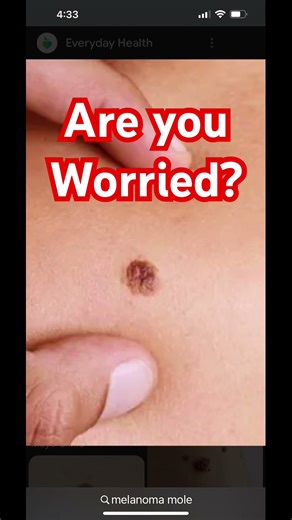 Mole or Melanoma? #cancerawareness #health #mole #melanoma