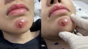 Painful Chin Abscess: Causes, Treatment, and How to Prevent Facial Skin Infections