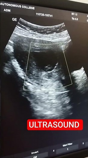 Basic of ultrasound