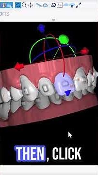 BSP5.0: Never Plan a Midcourse Refinement Case Ever Again! #aligners