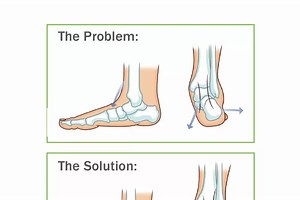 Are orthotic insoles a scam?