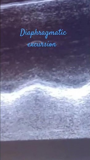 Diaphragmatic excursion // POCUS// ICU// CCM #criticalcaremedicine #medicine #medicalspecialty