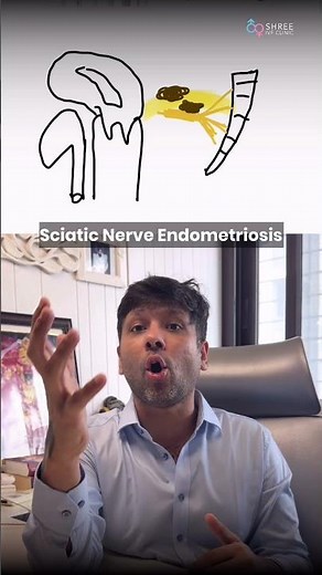 Sciatic Nerve Endometriosis Explained | Dr Jay Mehta, Mumbai #drjaymehta #endometriosis