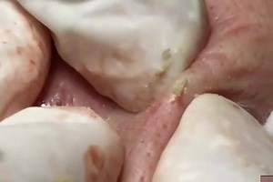 Pimple Popper Tools: https://amzn.to/2K5BKZZ Thinergy for Weight Loss: https://amzn.to/2RVogD0 Blackhead Masks: https://amzn.to/2Si7az4 Lighted pick for earwax and tonsil stones: https://amzn.to/2m4lVYa #pimplepopping #acne #zits #blackheadremoval #cysticacne #cysts #dermatology #poppers #pimplepoppers #popaholics #drpimplepopper #drpopper #iheartautopsy #mediciyne #zit #comedones #dilatedpores #dilatedporeofwiner I#comedoneextractor | CystBursting.com