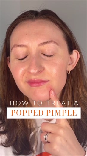 Treating Popped Pimples: A Comprehensive Guide