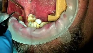 A "Live Demonstration of LANAP and LAPIP Treatments