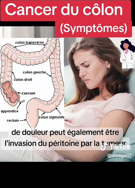 Cancer du Côlon : Symptômes et Conseils de Soins