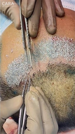 Hair Transplant in Mumbai using Sapphire FUE