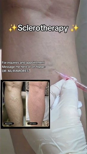 Sclerotherapy by Doc MJ ❤️ #docmj #sclerotherapy #sclero