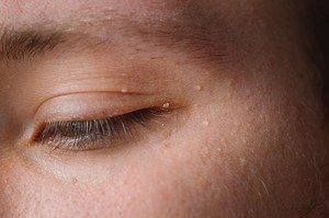 Milia - pimples around eye on skin. Eyes of young man with small...