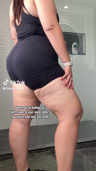 Lipoedema is a medical condition that is almost exclusively found in women and results in enlargement of both legs due to deposits of fat under the skin. Here are some symptoms that a lot of women with lipoedema have (including myself). I hope by continuing to spread awareness more women can get the diagnosis and medical help they need to navigate this condition ❤️ please reshare if you can fo spread the word #lipoedema #awarness #chronicillness