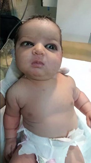 "Macrosomic Newborn Baby 4.4kg | C-Section Delivery | NICU Feeding & Congenital Care