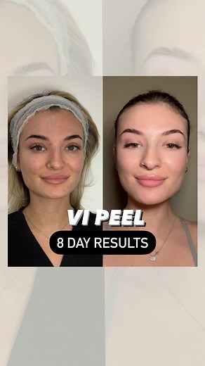 VLINE BEAUTY CLINIC MED SPA on Instagram: "Watch as the VI Peel works its magic over 8 days, revealing smoother, brighter, and more radiant skin😍✨ From peeling to revealing, see the power of this powerful skin treatment for yourself! Book your complimentary consultation now! 📞call our office! (847)660-6666! 🔗click the link in the bio to book online! #vipeel #chicagomedspa"