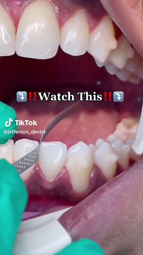 Improve Your Smile: Filing Between Teeth for Crowding Correction