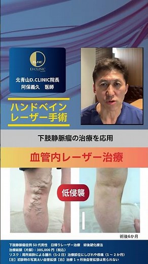 医療現場からの情報発信【ハンドベイン】3下肢静脈瘤を応用 #下肢静脈瘤 #手の血管 #ハンドベイン #日帰り手術 #医師が解説 #血管外科医 #東洋経済オンライン