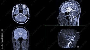 Comparison of MRI MRA brain for detect Brain disease.