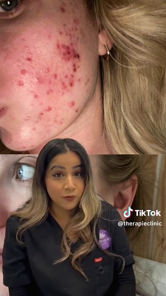 Take a look at these amazing Micro-needling results😍 #microneedling #beauty #therapie #clinic #results #beforeandafter #clearskin #fyp #trending #foryoupage #trend