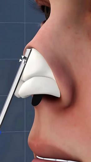 Rhinoplasty Nose Surgery (3D Animation) #rhinoplasty #nosesurgrey #plasticsurgery #rhinoplastybeforeafter #nosereshaping #medical3danimation #3dmedicalanimation #foryou #fyp | Life Health.