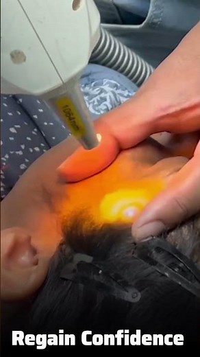 Remove Birthmarks Permanently with Laser? | Expert Guide