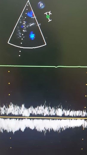 Case# 36 echocardiography bidirectional Glenn shunt